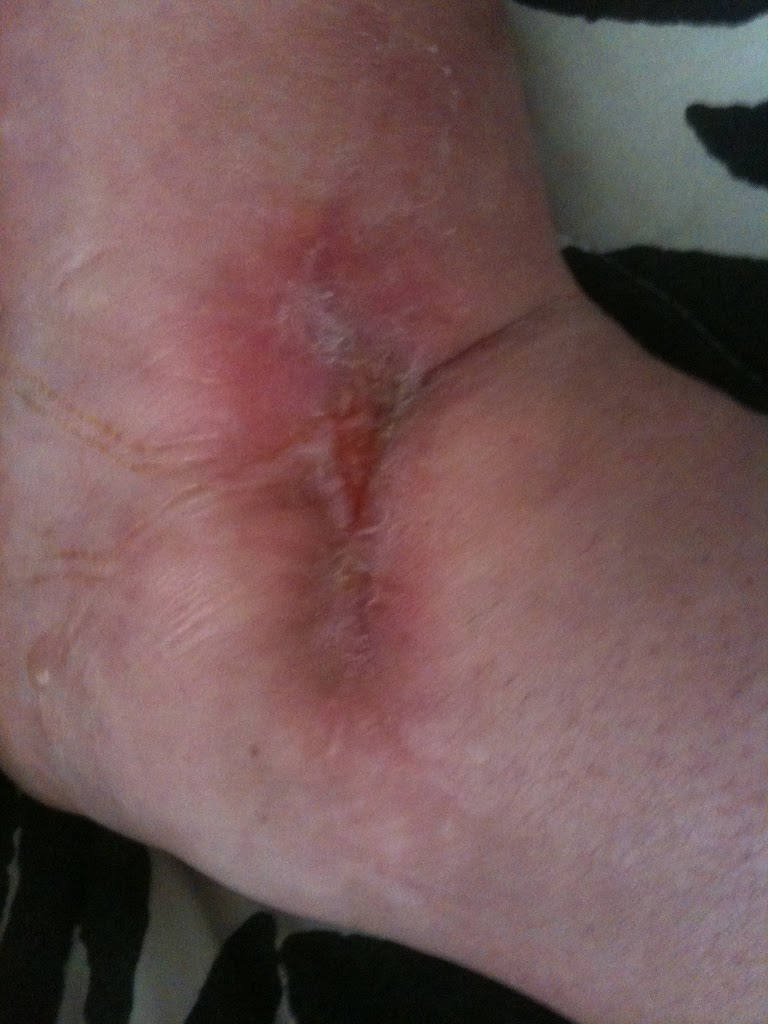 Ankle Wound Update Picture