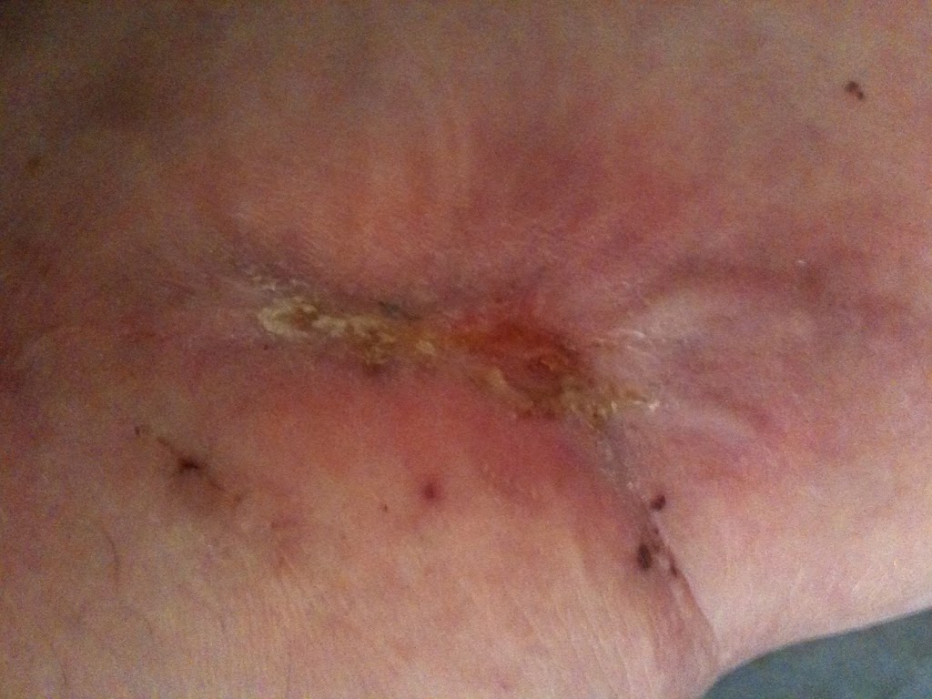 Wound Picture Update