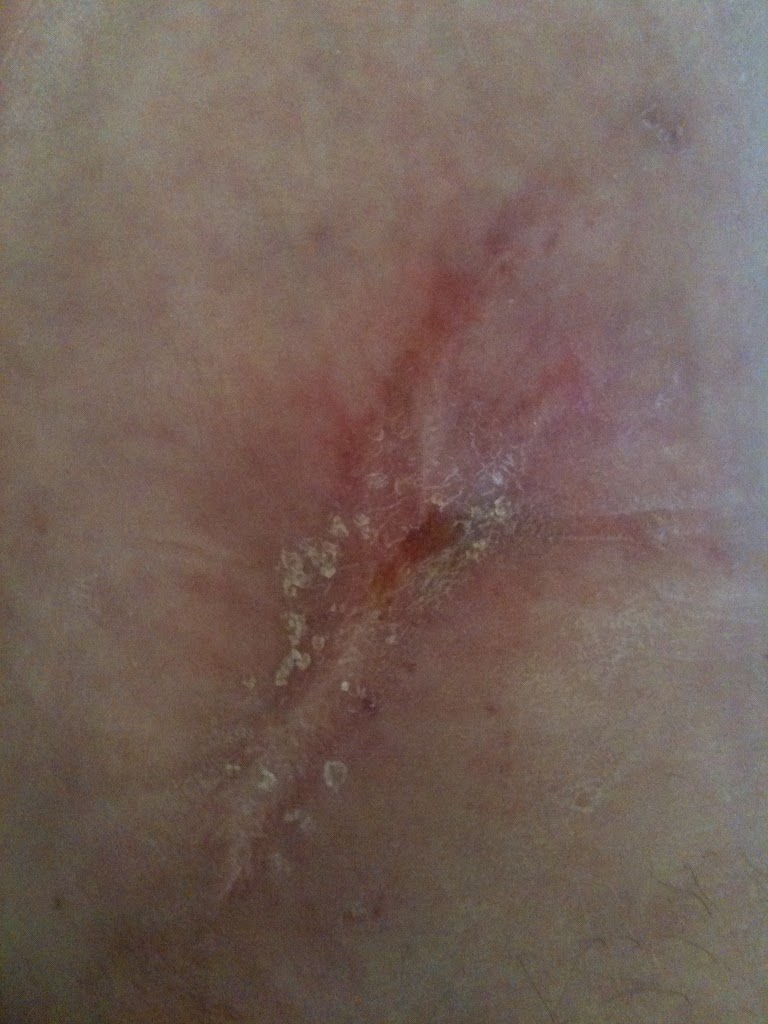 One year after the infection surgery