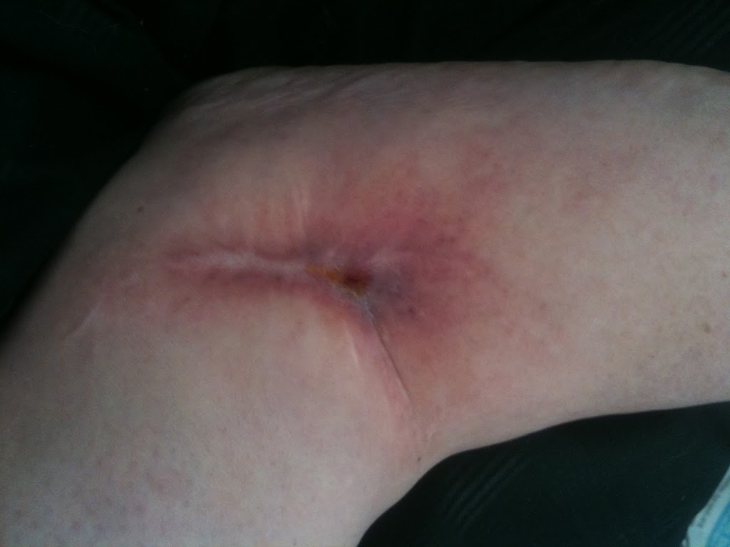 My cankle and wound pic update
